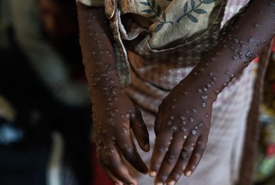 ဇင်ဘာဘွေတွင် ပထမဆုံးအကြိမ် mpox ၏ မျိုးကွဲအတိအကျမသိရှိသော...